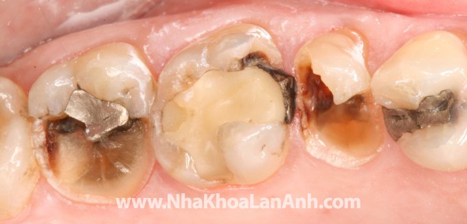 hinh: benh nhan co 3 rang ham can thay the bang onlay su.