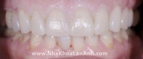Hình: Dựa vào mẫu răng sáp, bác sĩ sẽ làm răng tạm cho bệnh nhân. Răng tạm có màu vàng (màu răng bình thường) hoặc màu trắng sáng (dành cho răng tẩy trắng hoặc làm toàn hàm), giúp bệnh nhân hình dung được