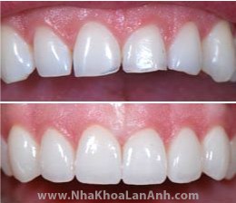 Rang bi me vo sau khi lam Veneer