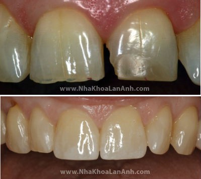 Hình: Răng bị mẻ vỡ trước và sau khi làm Veneer