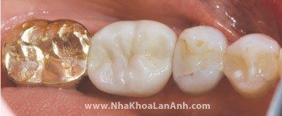 Hình: Răng được tái tạo bằng nguyên khối Zirconia, giúp chịu được lực nhai mạnh.