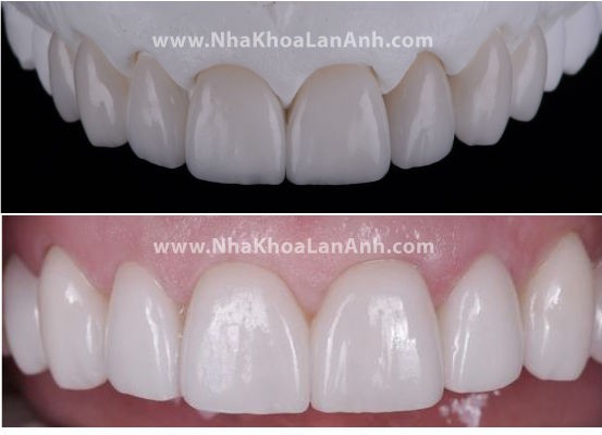 Hình: Răng sứ sau khi hoàn thành và gắn trên miệng bệnh nhân.