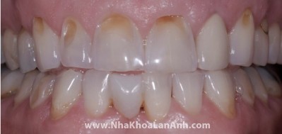 Rang truoc khi lam Veneer