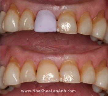 Hình: Tái tạo 1 răng cửa bị vỡ. Bác sĩ đã