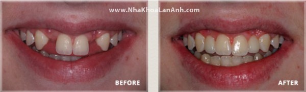 Hình: Cầu răng dán cho trường hợp bị thiếu răng cửa bên sau khi chỉnh nha: