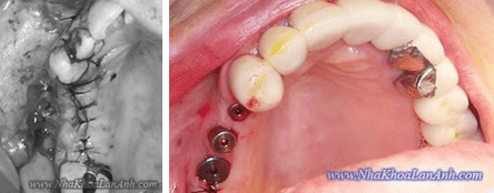 cung cay ghep 3 implant, nhung o hinh ben trai ky thuat rach nuou va lat vat se gay ra nhieu chan thuong, va thoi gian lanh thuong lau hon so voi ky thuat “khong lat vat” o hinh ben phai. tag: nha khoa tốt ở tphcm
