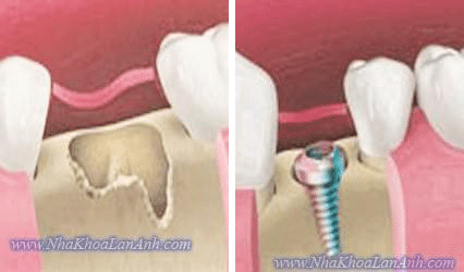 qua trinh lanh thuong khi nho rang va ghep implant trong cung 1 lan phau thuat. do tru implant dong vai tro nhu mot phan “xuong” cua o rang, nen viec tao xuong se nhanh hon, va lanh thuong cung nhanh va de dang hon