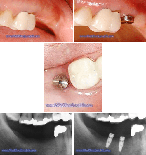 cay ghep implant truoc va sau khi phau thuat. vi khi mat rang, mach mau va than kinh tai noi do se bi suy thoai di, nen viec cay ghep implant se it dau va cung it chay mau hon so voi khi nho rang