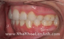 hinh: khoang trong rang sau khi chinh nha duoc dong kin. neu khong dung dung cu