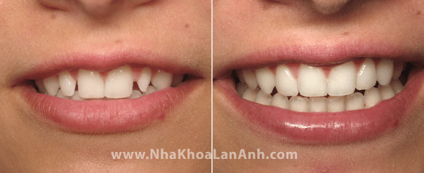 muc tieu cua chinh nha trong truong hop nay la chinh cac rang khac o vi tri tot de lam veneer.