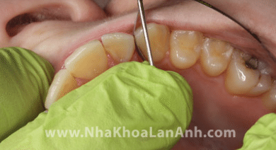 hinh: ky thuat