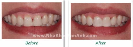 hinh: truoc va sau khi mai ke o rang co hinh tam giac va khe ho nuou, va duoc dong lai bang invisalign.