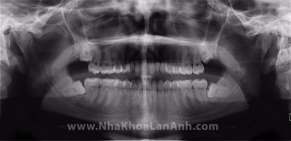 hinh: rang khon moc ket va moc ngam van co the gay anh huong den cac rang khac va day rang ra truoc.