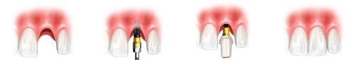 quy trinh dat implant lam rang su. tag: gia rang su, rang su nao tốt, trồng răng