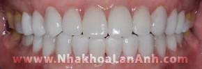 Gia rang su . Rang da gan veneer.