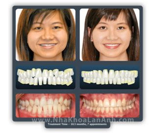 Hình: chỉnh nha cho người lớn cũng có thể đạt kết quả tốt, kể cả bằng mắc cài hay Invisalign.