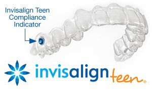 Khay Invisalign cho tre tuoi teen 1 _ nieng rang co dau khong