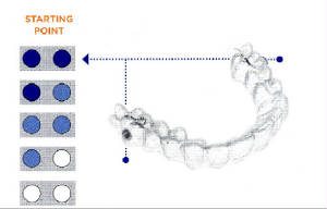 Khay Invisalign cho tre tuoi teen 2