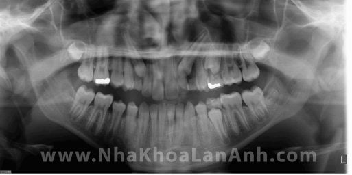 Hình: Phim toàn cảnh giúp bác sĩ thấy được răng nanh bị ngầm và mọc kẹt của trẻ. Rất nhiều phụ huynh không phát hiện được con mình có răng ngầm hoặc thiếu răng, cho đến khi bác sĩ thông báo cho phụ huynh!