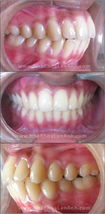 Hình: Nhiều phụ huynh khi nhìn thẳng sẽ không thấy răng trẻ bị hô nhiều. Nhưng khi nhìn ở góc độ nghiêng và qua phim x-quang sẽ thấy trẻ hô nhiều hơn họ nghĩ.