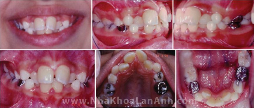 Hình: Răng vĩnh viễn bị thiếu chỗ mọc dẫn đến tình trạng chen chúc. Bác sĩ sẽ đánh giá việc cần thiết can thiệp sớm cho trẻ, nhưng phụ huynh cần hiểu là nếu can thiệp sớm khi răng vĩnh viễn chưa mọc hoàn toàn, thời gian có thể lâu hơn bình thường.