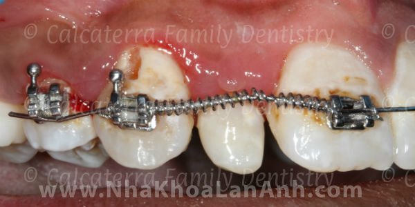 Hình: sâu răng ở trẻ em mang mắc cài không vệ sinh răng miệng tốt.