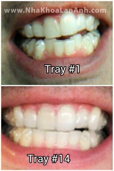 Hình: hình chụp thực tế khi bệnh nhân đeo khay Invisalign cho trường hợp rang chen chúc nhẹ sau thời gian 6 tháng. Kết quả đạt được khá tốt.