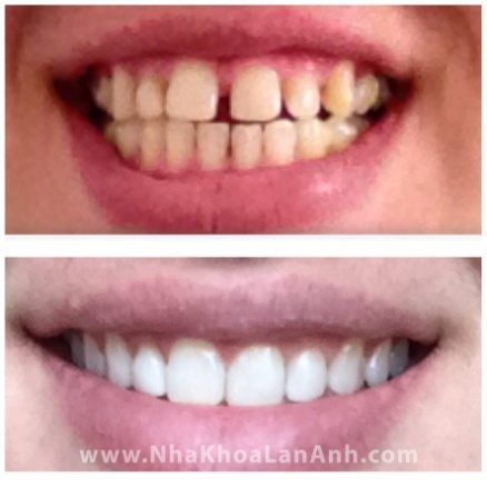 Invisalign chi dinh giu nguyen