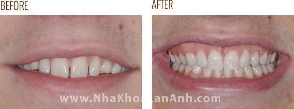 Invisalign khong can di chuyen nhieu rang