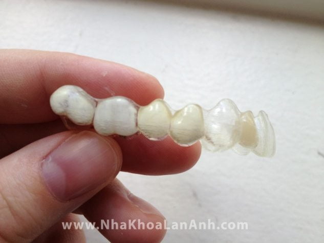 Lam rang tam khi su dung he thong Invisalign 1