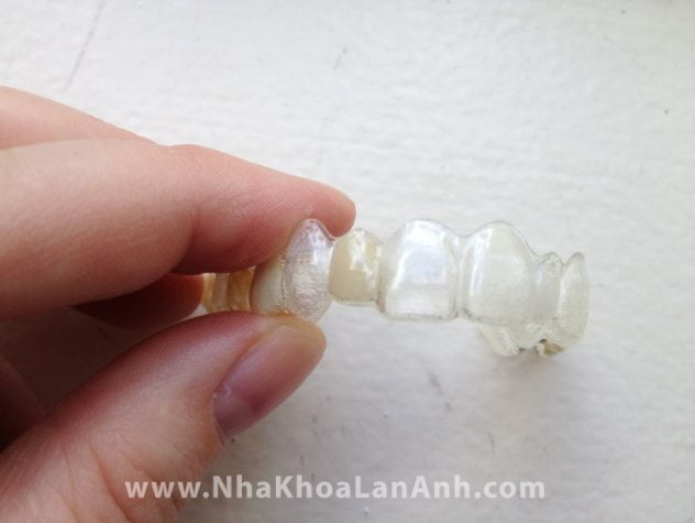 Lam rang tam khi su dung he thong Invisalign 2