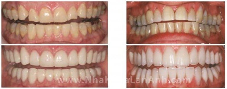 Mau-sac-tham-my-cua-rang-su-Cerec- nha khoa tốt ở tphcm