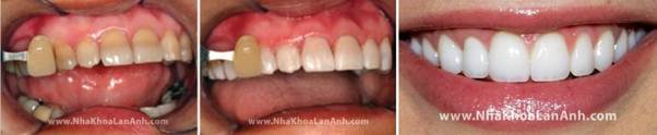 Rang nhiem Tetracycline duoc tay trang