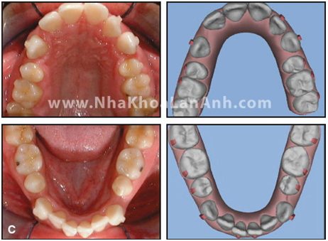 Su di chuyen cua rang theo khay Invisalign