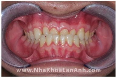 Truong hop dieu tri Invisalign tai nha khoa 1