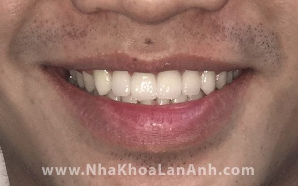 Hình: thực tế một trường hợp điều trị bằng Invisalign tại nha khoa Lan Anh. Thời gian điều trị chỉ là 15 tháng, trong khi đối với mắc cài, chắc chắn thời gian sẽ lâu hơn!
