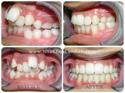 Hình: trường hợp răng chen chúc nặng, trục răng ở nhiều hướng khác nhau nên không thể lắp khay Invisalign ôm vào bề mặt của răng được. Vì vậy, bác sĩ sẽ tư vấn bệnh nhân chọn hệ thống mắc cài.