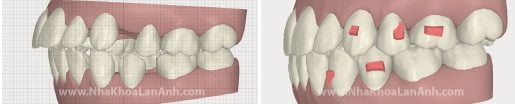 Benh nhan can 29 khay invisalign