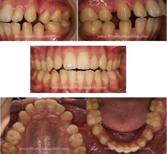 Benh nhan chuyen tu mac cai sang Invisalign