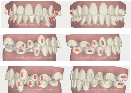 Hinh anh mo phong tren phan mem cua Invisalign 1