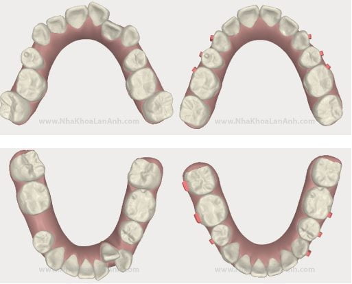 Hinh anh mo phong tren phan mem cua Invisalign 2