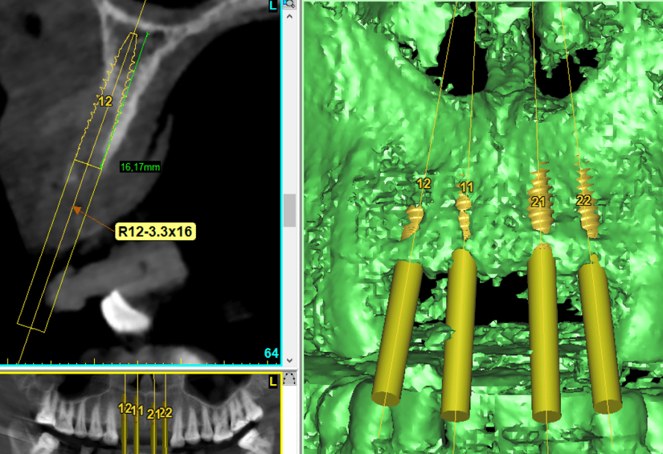 phim ct cone beam cho thay vung rang cua co xuong qua mong can ghep xuong de dat implant