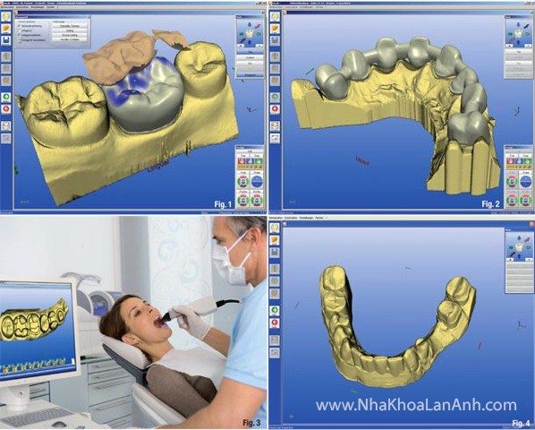thiet ke rang su cad/cam cerec. bac si dung he thong camera omnicam de quet hinh anh tren mieng benh nhan, tu do sao luu vao may vi tinh va thiet ke rang su tren may vi tinh. neu dung he thong inlab, bac si se lay dau de lam mau ham cho benh nhan.