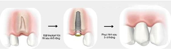 dat implant tuc thi sau khi nho rang giup han che toi da thoi gian mat rang