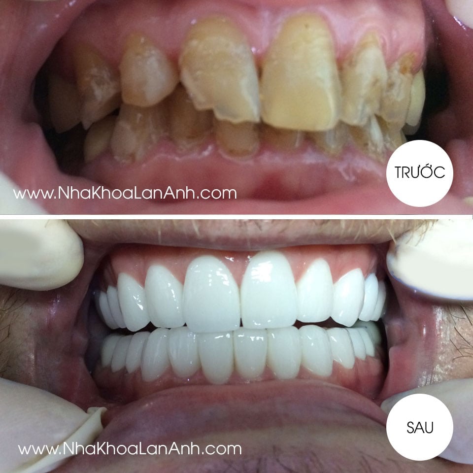 Case phuc hinh rang su Cercon