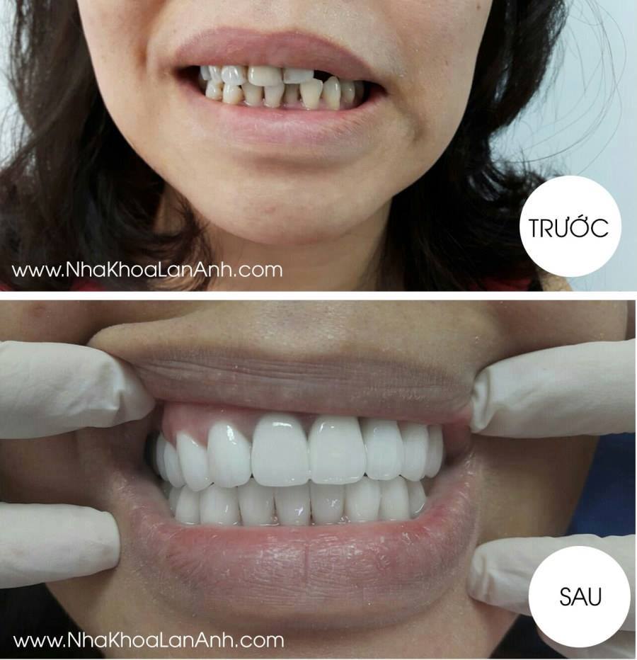 Phuc hinh bang rang su Zirconia
