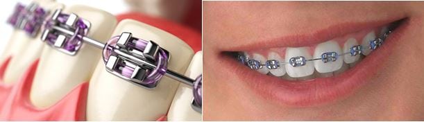 Hình ảnh niềng răng bằng khay Invisalign 2 hinh-anh-nieng-rang-bang-khay-invisalign-2