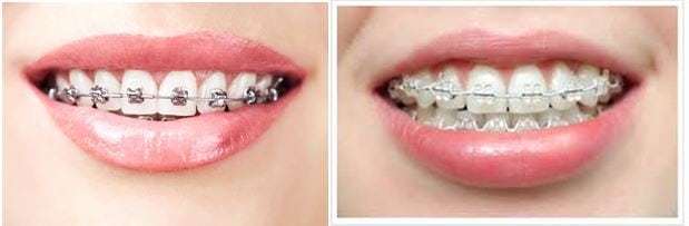 Hình ảnh niềng răng bằng khay Invisalign 3 hinh-anh-nieng-rang-bang-khay-invisalign-3