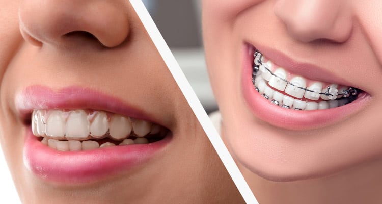 Hình ảnh niềng răng bằng khay Invisalign 4 hinh-anh-nieng-rang-bang-khay-invisalign-4